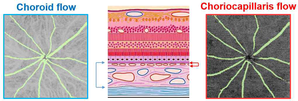 Retina와 choroid 층의 모식도(中)와 choroid의 혈류(左)와 choriocapillaris의 혈류(右)의 위치 및 혈관 구성의 차이점을 나타낸 그림. 모식도에서 나타나듯이 choriocapillaris는 choroid층의 가장 위쪽에 존재하며 미세혈관만으로 구성되어 미세혈류장애를 효과적으로 보여줄 수 있는 층이다. 두꺼운 혈관으로 구성된 choroid층과 달리 choriocapillaris는 구름 모양으로 혈관이 퍼져있음