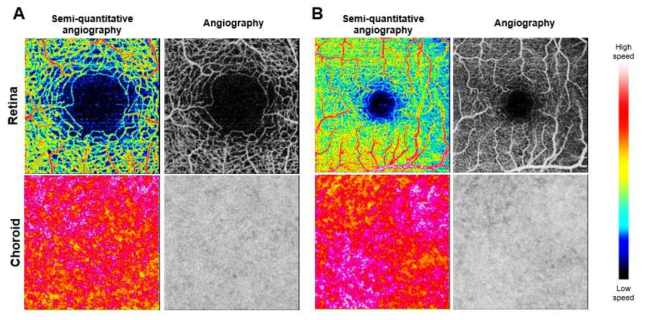 사람의 정상 안구를 촬영한 미세혈류속도 측정을 위한 OCTA imaging 결과. Retina와 choroid에서 상대미세혈류속도 정보(BFI) 이미지(semi-quantitative angiography)와 미세혈류구조 이미지(angiography)를 효과적으로 이미징하여 사람 안구에서의 미세혈류속도 측정 가능성을 보여줌. 동일 안구에서 (A) 2mm x 2mm, (B) 4mm x 4mm의 FOV 영역을 촬영함