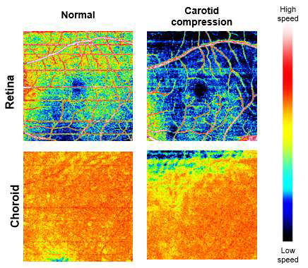 사람의 정상 안구를 촬영한 뒤, 경동맥을 압박하여 인위적으로 혈류속도가 감소하였을 때의 모습을 OCTA를 통해 촬영한 모습. 5mm x 5mm의 FOV 영역을 촬영함. 경동맥을 압박하였을 때 retina와 choroid에서의 혈류속도가 감소함이 관찰되어 사람 안구에서 미세혈류속도 변화의 측정 가능성을 효과적으로 보여줌