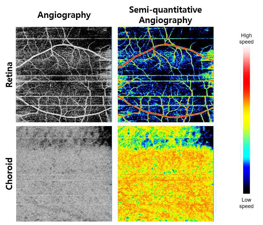 중환자 안구의 미세혈류속도 측정을 위한 OCTA imaging 결과. Retina와 choroid에서 상대미세혈류속도 정보(BFI) 이미지 (semi-quantitative angiography)와 미세혈류구조 이미지 (angiography)에서 혈류속도가 감소되어 있음을 보여줌