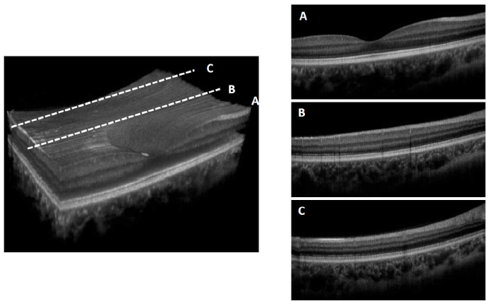KAIST 시스템으로 이미징한 정상 망막의 3차원 미세구조영상
