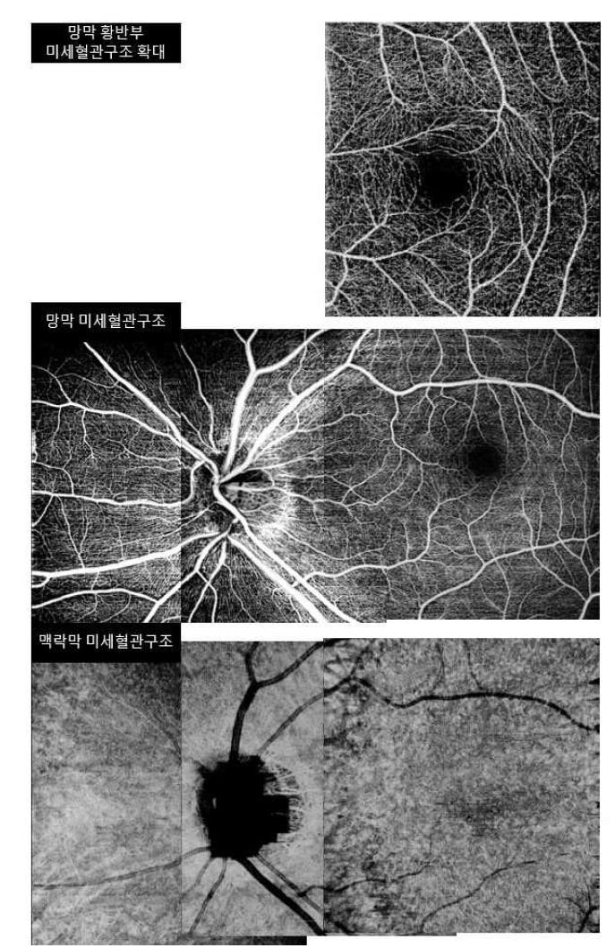 KAIST 시스템으로 이미징 한 정상 망막/맥락막 혈관구조. 6mm x 6mm 이미지를 여러 번 찍음으로써 황반과 ONH를 동시에 영상화 할 수 있다. (상) 망막 황반부 (3mm x 3mm). (중) 망막 층 미세혈관구조 (12mm x 6mm). (하) 맥락막층 미세혈관구조 (12mm x 6mm)