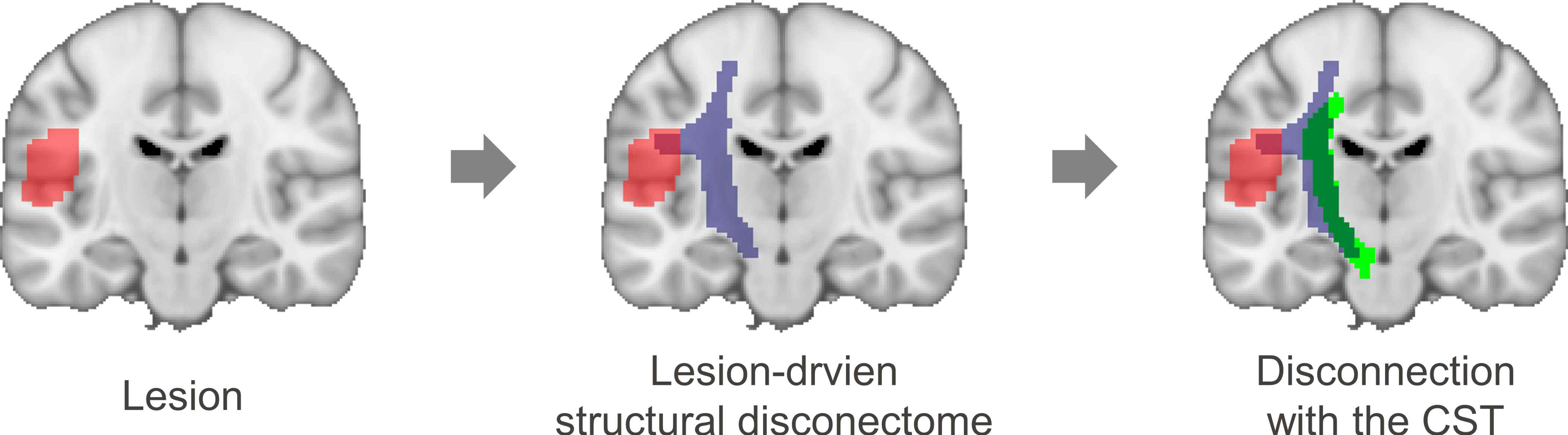 손상 뇌영역에 대한 구조 디스커넥톰 측정 과정. CST, corticospinal tract