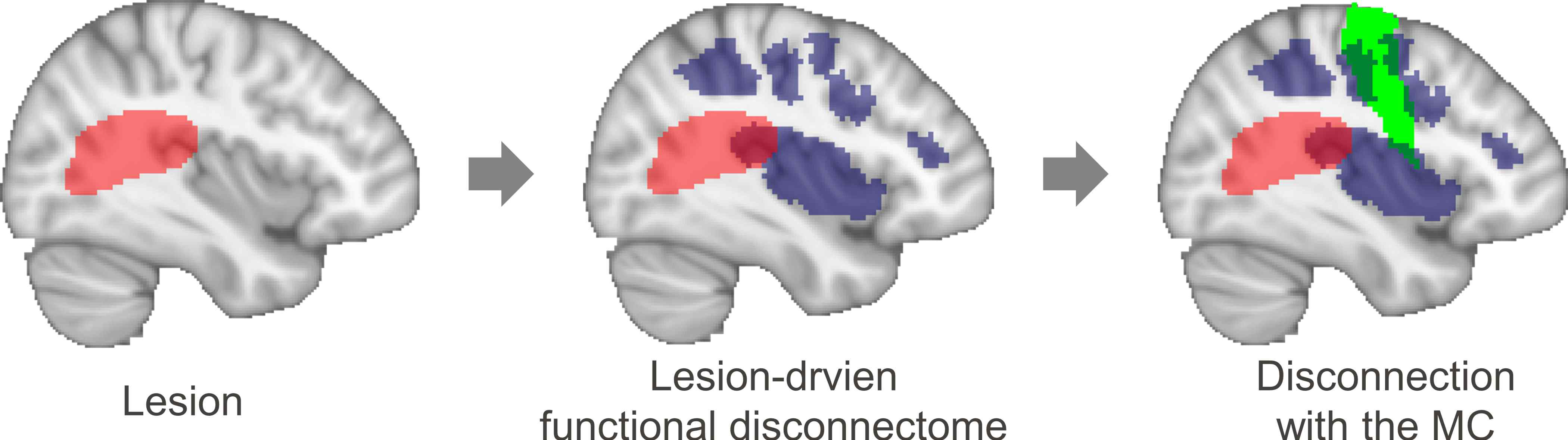 손상 뇌영역에 대한 기능 디스커넥톰 측정 과정. MC, motor cortex