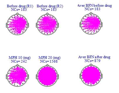 Brain functional connectivity under medication (Subject 2)