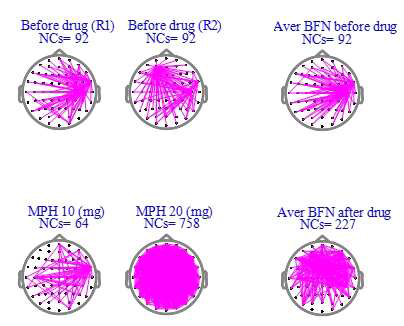 Brain functional connectivity under medication (Subject 1)