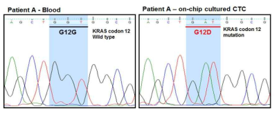 Gene sequencing을 통한 췌장암 환자 혈액의 KRAS codon 12번 mutation 확인