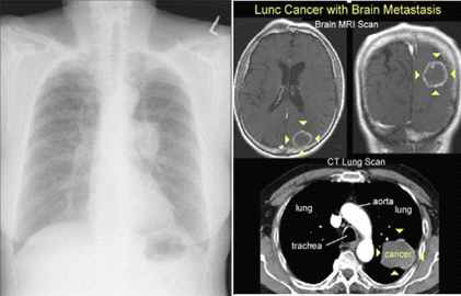 소세포폐암 사례 - 좌측 폐 중격부근의 병소 및 뇌 전이 (오른쪽)