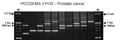 PDCD6-MS3 전립선암 환자에서 패턴 분석