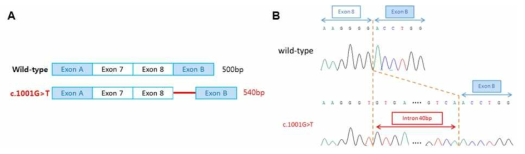SLC26A4 유전자의 c.1001G>T 돌연변이의 intron 부분에 발생한 비정상적 스플라이싱 모식도(A)와 염기서열분석 결과(B)