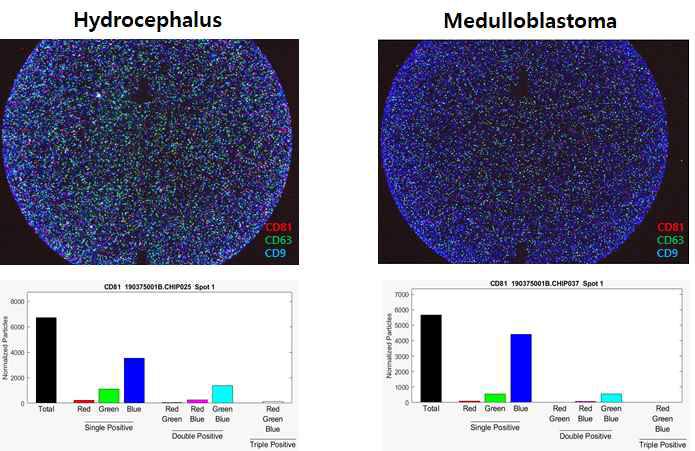 Exoview 를 이용한 exosome 표지자 CD81, CD63, CD9 을 확인하고 EV의 크기, 수, 분포를 CSF 샘플에서 동시에 확인함