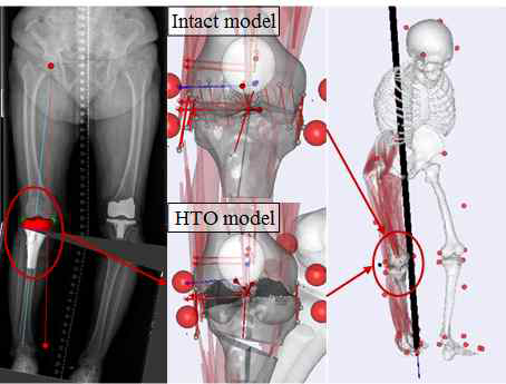 가상 절골술 방법을 이용한 상세 무릎모델이 포함된 근골격 모델 개발 및 수술 전/후의 보행 시뮬레이션