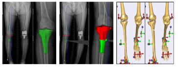 가상 HTO 절골술 수술 전(왼쪽)과 수술 후(가운데)(파란색선: 수술 전 기계적 정렬축, 빨간색선: 경골 윗면, 초록색선: 절단 부위, 연두색선: 수술 후 메카니컬 엑시스), 가상 수술 전/후의 근골격 모델 및 인체 동역학 시뮬레이션(오른쪽)