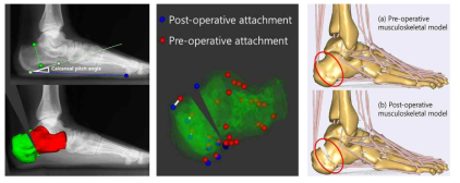 CT영상에서 생성된 종골 모델을 방사선영상에 정합하여 가상 종골절골술(CO)을 하고(왼쪽), 근육 및 인대의 부착 위치를 재계산하여(중간), 근골격 모델을 생성함(오른쪽)