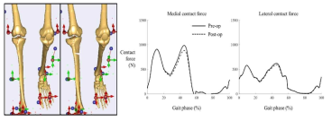 open-wedge 방법의 근위경골절골술 전/후의 근골격 모델 및 인체 동역학 시뮬레이션(왼쪽) 및 보행 동안의 수술 전/후 무릎의 내측 접촉힘 및 외측 접촉힘 그래프 (오른쪽)