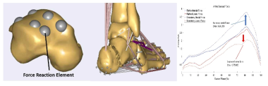 발목관절 내외측에 삽입한 Force Reaction Element(왼쪽), 가상 종골전위절골술 후의 근골격 모델 및 인체 동역학 시뮬레이션(중간), 절골술 전/후의 발목 내외측 접촉력 예측 및 비교(오른쪽)