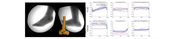 구조물이 있는 족부 관절의 엑스선영상데이터와 3차원 골형상 모델(왼쪽)과 질병 환자의 발목 관절 및 거골하 관절에서 3자유도 회전 운동 분석(오른쪽)