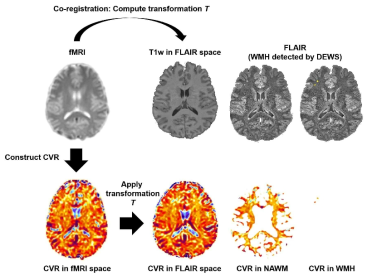 Cerebrovascular reactivity (CVR) in white matter hyperintensities (WMHs) and normal-appearing white matter (NAWM)