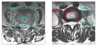 Detection Model을 이용한 결핵성과 화농성 척추염 감별기의 예시