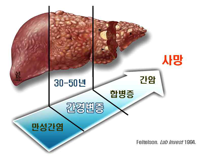 Progression from chronic hepatitis to liver cirrhosis and liver cancer