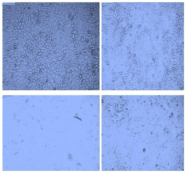 Treated U87MG cells under microscope after Trypan blue addition