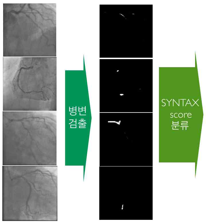 SYNTAX score 계산의 단계