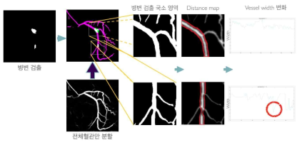 병변 검출 방식의 인공지능 SYNTAX score 계산법