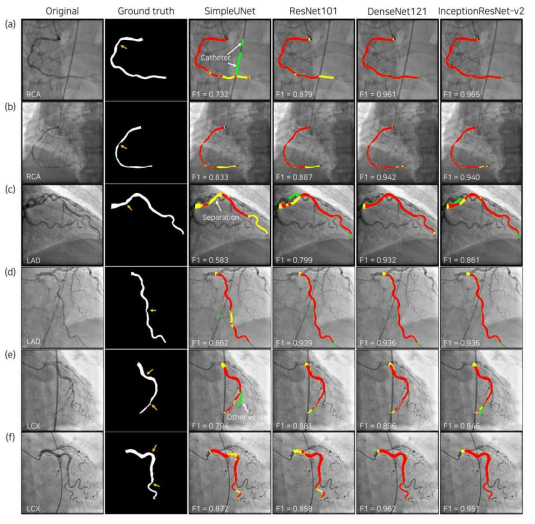 인공지능 기반 혈관 분할 알고리즘의 적용 (Yang et al., Scientific reports, 2019)