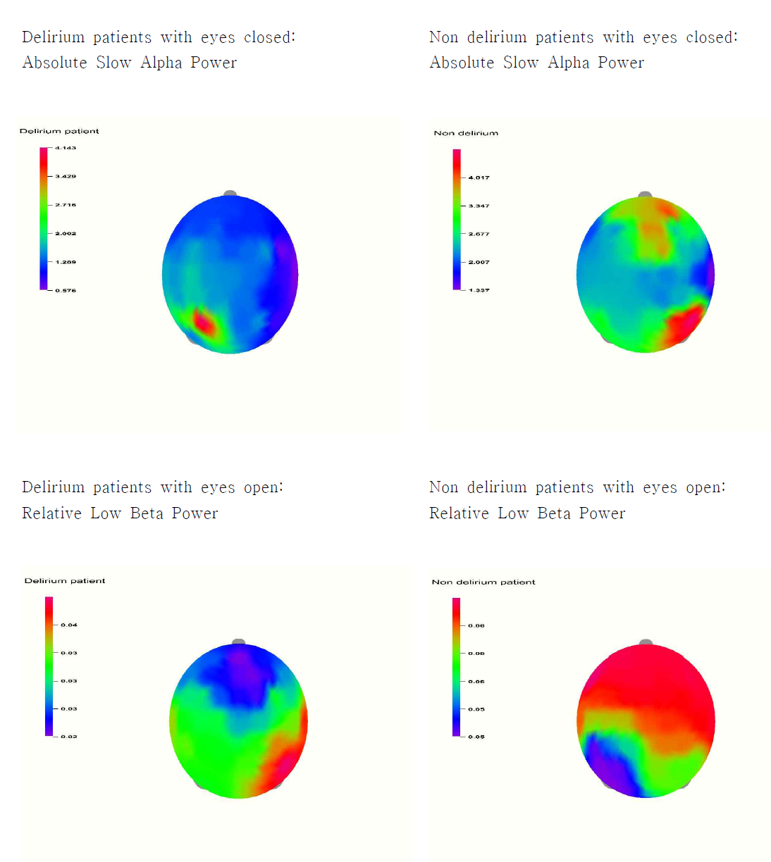 Examples of the EEG(Electroencephalography) and brain mapping