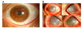 (A) 정상 투명 각막 (노랑 점선 원 내측). (B) 외상, 백내장 수술, 각막 질환 등으로 인한 비대상성 각막 내피손상 (수포성 각막병증)으로 실명한 환자들의 모습