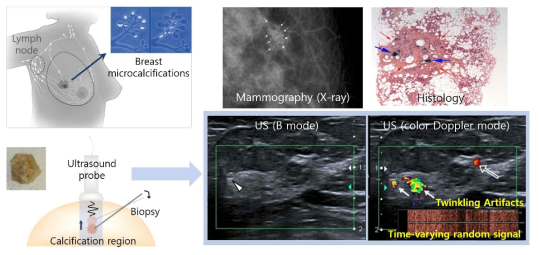 유방 미세석회화 생성모습 및 현재의 유방 미세석회화 검출방법 예시(유방촬영술, 조직검사, B모드 초음파, 컬러 도플러 초음파)