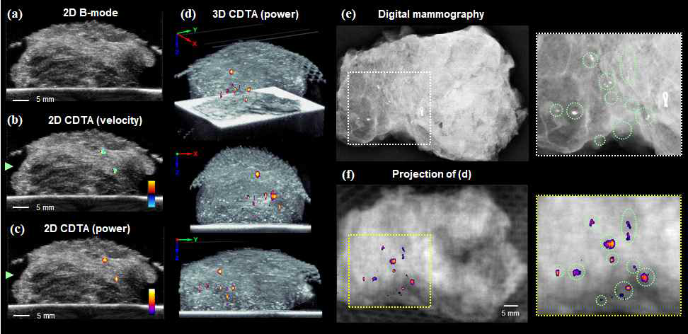 개발한 기술을 활용한 실제 인체 미세석회화 조직(surgical biopsy sample) 실험 결과. (a)-(c) 초음파 2차원 스캔 결과(B-mode, color-mode, power-mode). (d) 초음파 3차원 스캔 결과. (e)유방촬영술 결과. (f) 초음파 3차원 데이터를 활용한 투사영상 비교결과 (민감도 측정: 미세석회화 그룹 별 100% 검출 / 각 입자 별 87.5% 검출)