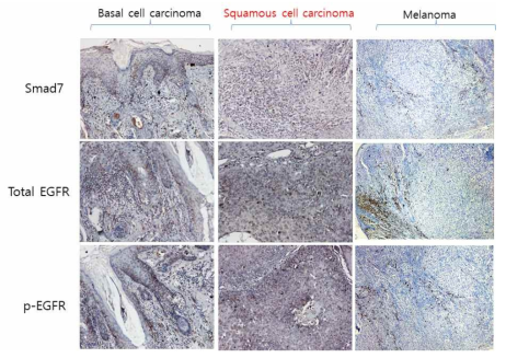 피부암 환자 조직에서 Smad7의 발현 검증