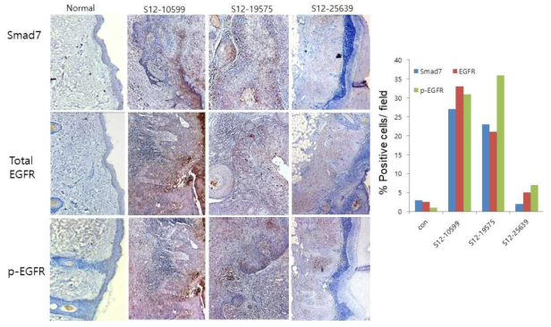 Squamous cell carcinoma 조직에서 Smad7과 EGFR의 발현 검증
