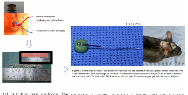 Button type electrode. The electrode composed of a cap of metal bolts and a plastic button connected with 3 cm flexible wire. This button type of electrodes was implanted simultaneously during ULx to the lateral aspect of the horizontal canal for both sides. The free wire’s tail was used for connecting the galvanic device via alligator connectors