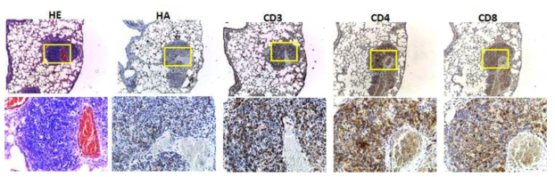 CTLA4-CD28 융합유전자 생쥐 lung 대상 immunohistochemical staining. H&E stain을 통해 침윤된 림프구 세포가 확인되었고 HA+ 세포가 보인다. 위쪽 panel 내 노란색 박스는 아래 확대되어 보인다