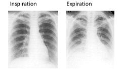 호흡에 따른 심장 위치의 변화, 흉부 X선