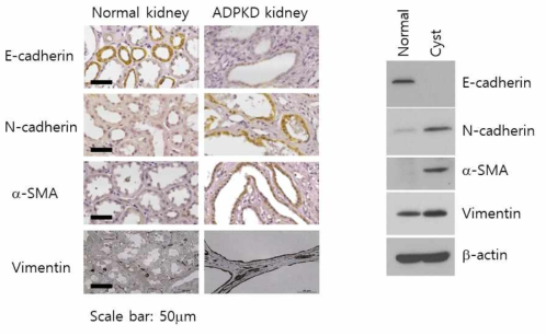 왼쪽은 EMT 관련단백질들의 발현을 정상인과 다낭신 환자 신장 조직에서 조직형광염색법(IHC)로 조사한 것이고 오른쪽은 낭종 세포에서 각 단백질들의 발현을 Western blot으로 확인. Epithelial 마커 단백질: E-cadherin, Mesenchymal 마커 단백질: N-cadherin, α-SMA, vimentin