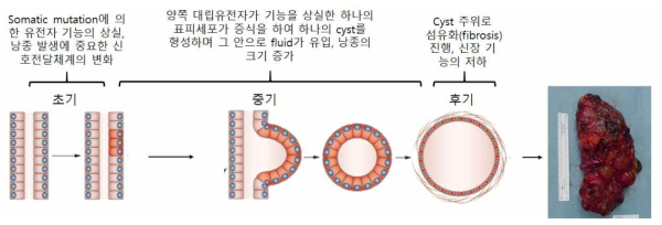 상염색체 우성 다낭신의 낭종 형성과 병의 진행