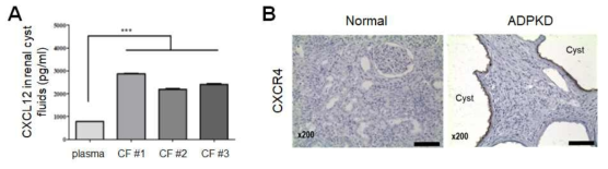 (A) 다낭신 환자의 신장 낭종에서 추출한 낭종액에서 CXCL12의 양 비교 (B) 정상인과 다낭신 환자의 신장 조직에서 CXCR4의 발현을 IHC로 조사