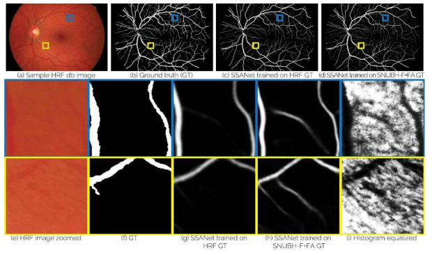 본 연구로 구축된 신규 DB(SNUBH-F+FA GT)로 학습된 SSANet을 HRF 영상에 적용하여 추출된 혈관의 사례. HRF에 포함된 참값 혈관 영역에서는 제외된 미세한 혈관(f)이 신규 DB(SNUBH-F+FA GT)로 학습된 혈관 추출 결과 (h)에서는 추출되는 것을 확인할 수 있다. 실제 그 부분에 혈관이 있을 가능성이 높음을 (i)의 영상 처리 기법을 통해 확인할 수 있다