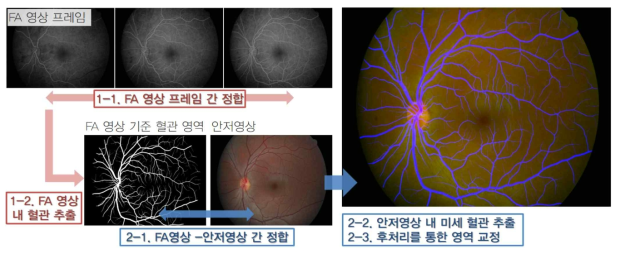 제안하는 연구의 개요. 미세한 혈관이 더 명확하게 드러나는 형광조영영상(FA) 내의 혈관을 우선 추출한 다음, FA 영상-안저영상 간 정합을 통해 추출된 혈관을 기반으로 하는 안저영상 내 혈관 영역을 도출하는 기술을 개발하고자 함