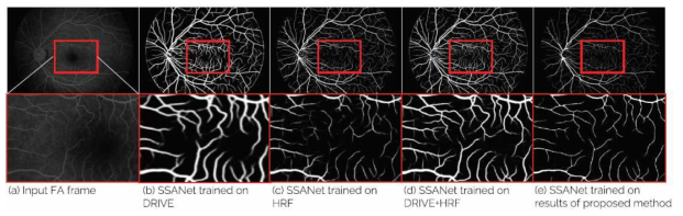 DRIVE, HRF 등 공개된 안저영상 학습 DB에 학습된 SSANet을 이용한 FA 혈관 추출 결과의 예