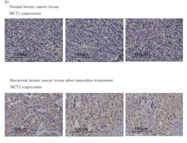 인체 유방암시료에서 MCT-1 발현 양상 평가