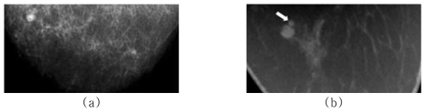 (a) 유방 촬영술 영상과 (b) 유방 CT 영상