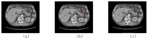 (a) 표준 선량으로 복원된 CT 영상, (b) 저선량 CT 영상, (c) 컨볼루셔널 심층신경망 적용 영상