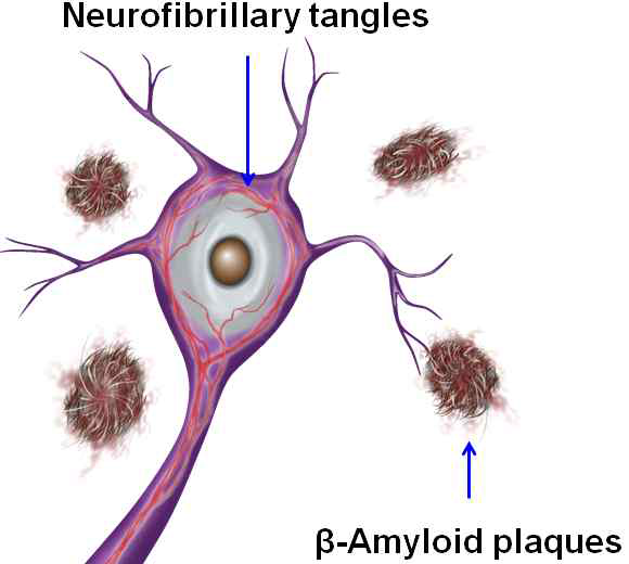 뇌신경세포 안에 존재하는 NFT와 세포 밖에 존재하는 베타-아밀로이드 플라그