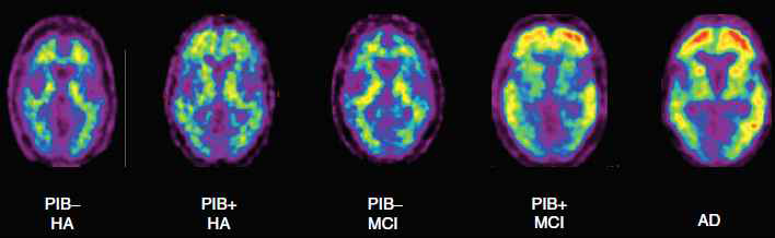 11C-PIB PET 영상: 정상인, MCI, 알츠하이머병 환자