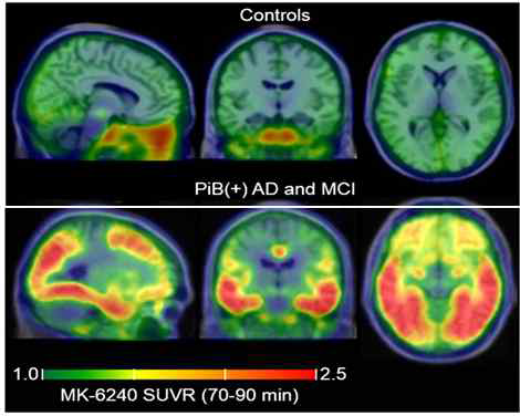 정상인과 치매환자의 18F-MK6240 뇌 PET 영상 : 타겟 영역에서 18F-MK6240 결합패턴은 뇌병리 NFT 타우 스테이징과 일치함