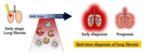 MMP를 이용한 폐 섬유증 질환의 실시간 진단 방법